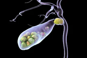 Calculs biliaires... comment se forment-ils et quelles sont les méthodes de diagnostic ?