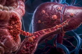 Comment le cancer du côlon se transforme en une version capable de conquérir le foie ?
