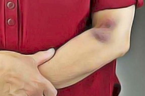 ما هي أسباب الكدمات المتكرِّرة في الجسم؟