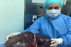 إزالة ورم يتجاوز 17 كيلوغراماً من بطن امرأة إماراتية