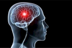 الأعراض الثمانية الأكثر شيوعا للسكتة الدماغية!
