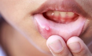 فطريات الفم.. أسبابها وأعراضها