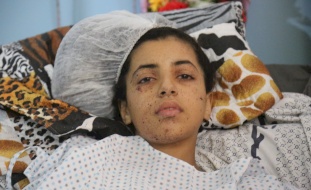 خاص- الطفلة رهف فقدت أطرافها في العدوان على غزة ولم تفقد الأمل 