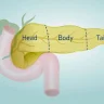 New Drug Gives Hope to Pancreatic Cancer Patients