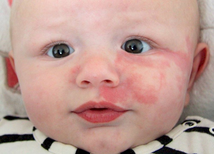 جديلة خيالية سهلة الفهم بقع حمراء على الجلد تختفي عند الضغط عليها Dsvdedommel Com