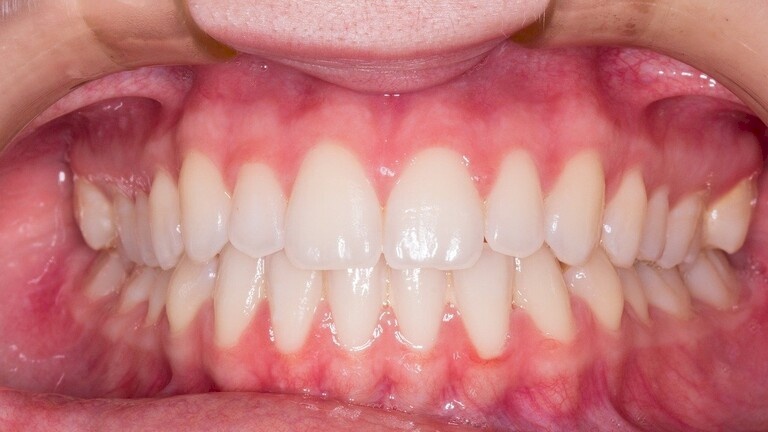 اضطراب في النوم قد يكون السبب في