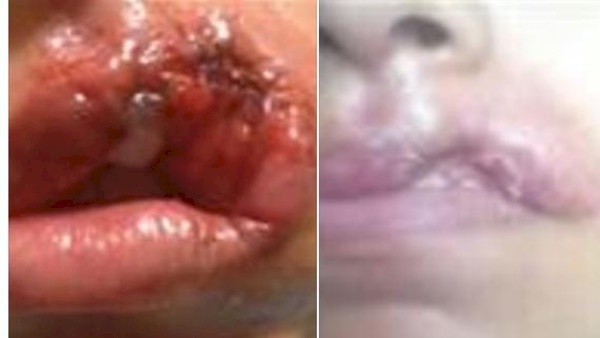 هذا ما فعله طبيب تجميل بشفتي فتاة مصرية..والقضاء ينصفها
