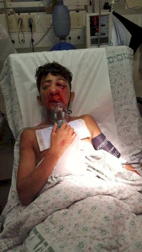 الاحتلال يصيب طفلا في العيسوية 