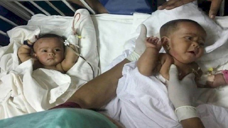 أول عملية ناجحة لفصل توأمين سياميين في بنغلاديش