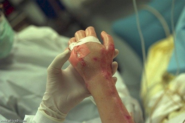 في الخليل.. اصيب بحروق نتيجة انفجار العاب نارية
