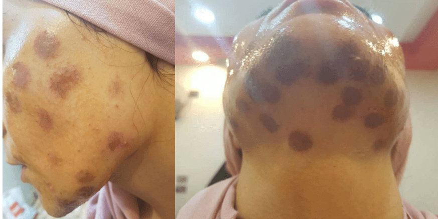 صورة| ضحية جديدة لعمليات التجميل تشوه وحروق!