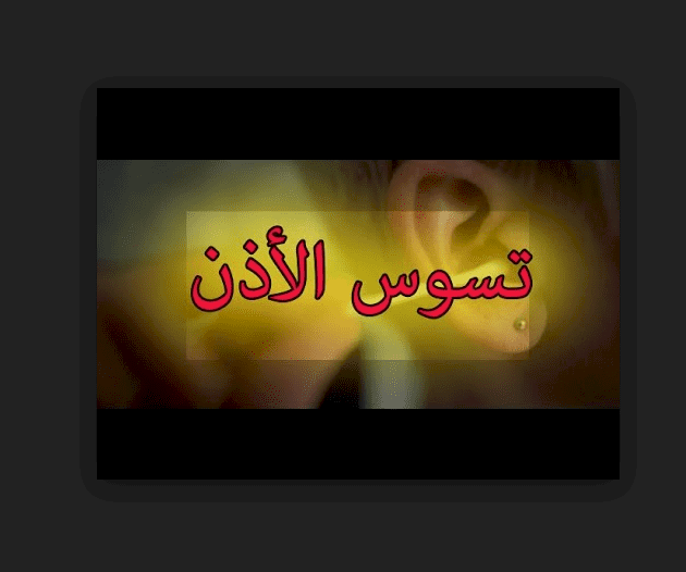 هل سمعت يوماً عن "تسوّس الأذن" ؟!