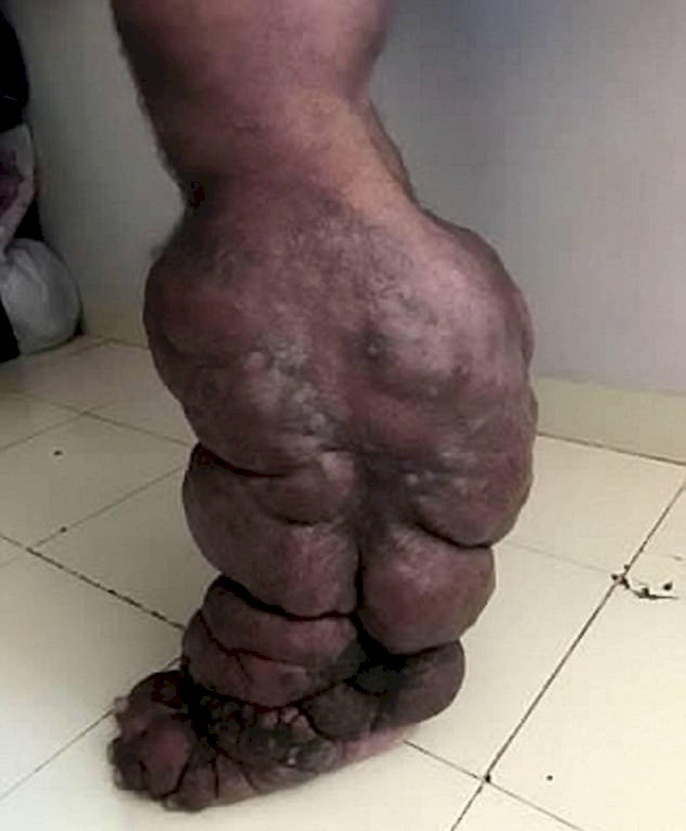 بعد لسعة بعوضة له.. اصبحت رجله هكذا! 
