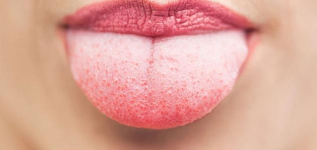 نمو الوبر على اللسان.. كيف تتفادونه وما هي أسبابه؟