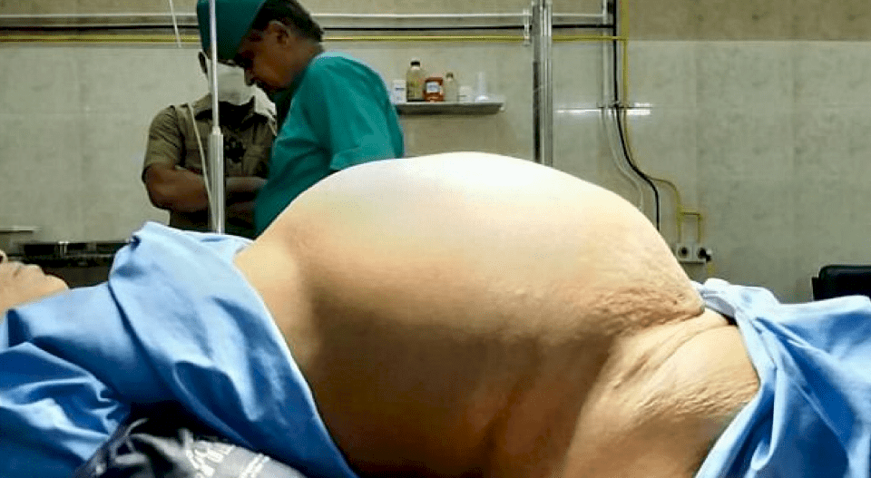 هذه السيدة استأصلوا ورماً يزن 11.8 كيلوغراماً من مبيضها!