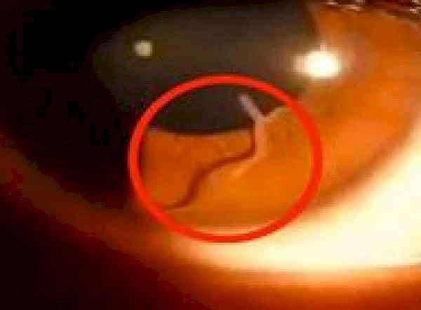 صور| لقطات مروعة لدودة تخرج من عين سيدة