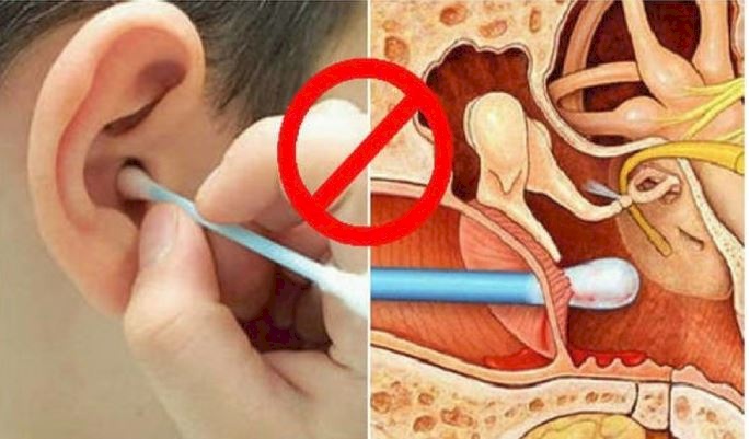 هل تؤدي أعواد القطن إلى فقدان السمع؟