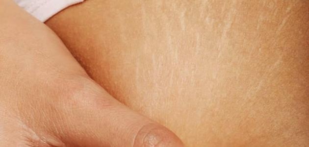 3 طرق للتخلص من تشققات الجلد