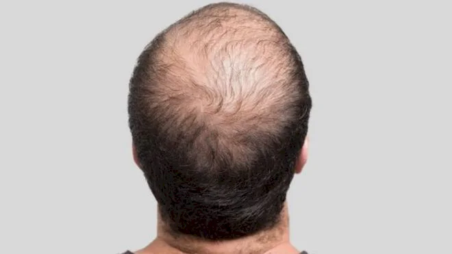 اكتشاف علاج جديد يعزز نمو الشعر ويقضي على الصلع