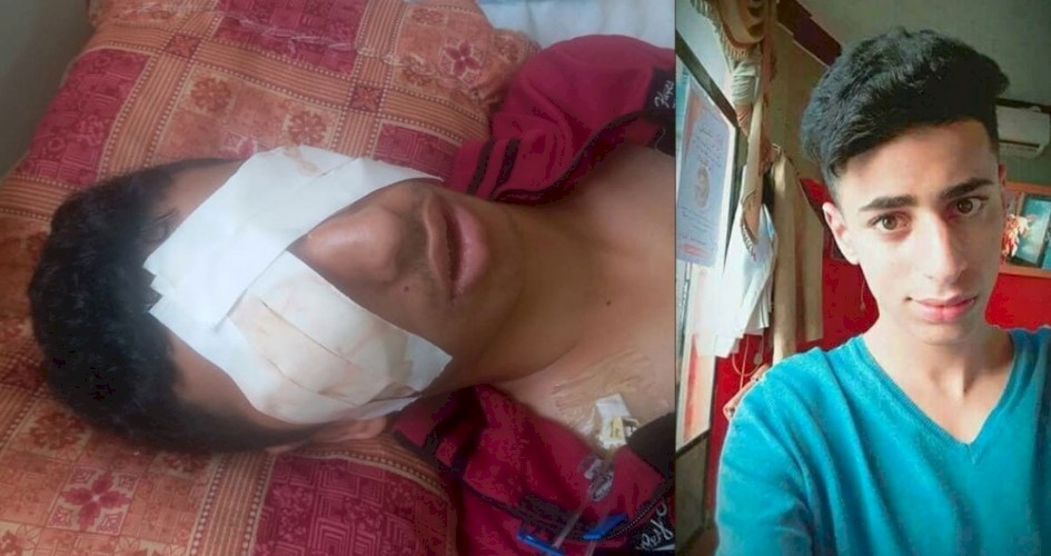 مناشدات لإنقاذه.. طلق نارى متفجر أفقد الطفل صالح أعز ما يملك