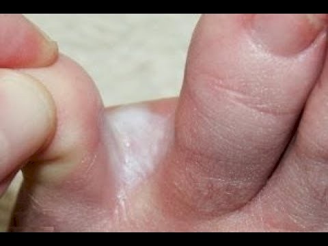 تعرف كيف تحمي نفسك من فطريات القدم
