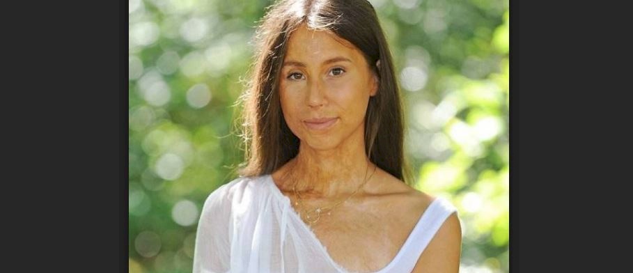 أحرقوا وجهها بالأسيد... هكذا كانت وهكذا أصبحت بعد 70 عملية تجميل