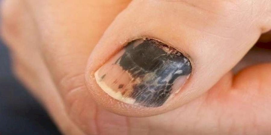 الأظافر تساعد في تشخيص السرطان