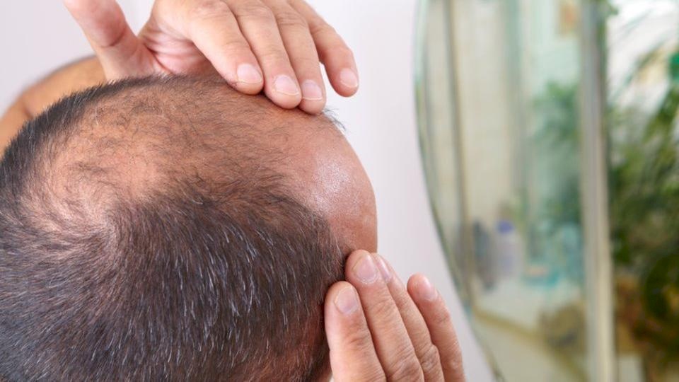 علاج "مفاجئ" للصلع .. برائحة جميلة تستخدم للعطور