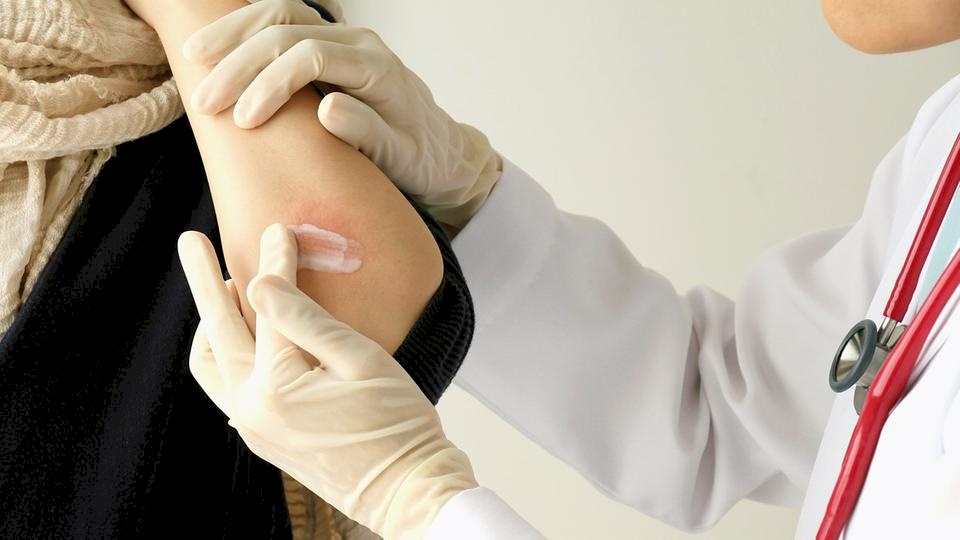 لتخفيف أعراض الصدفية.. إليك بالطب البديل