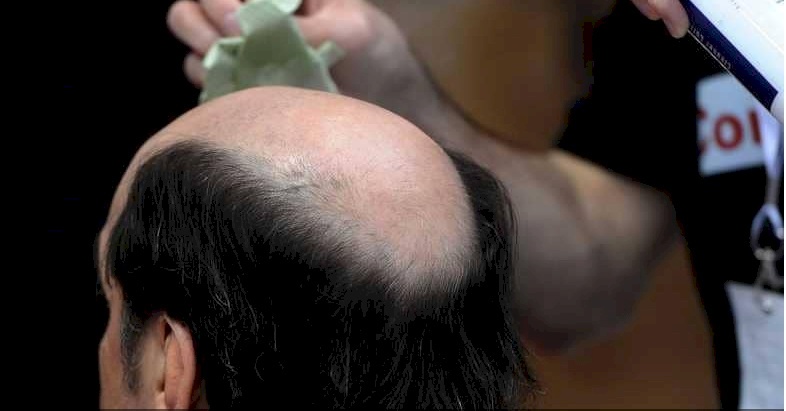 علماء يكتشفون علاجا لمشكلة الصلع التي تؤرق الملايين