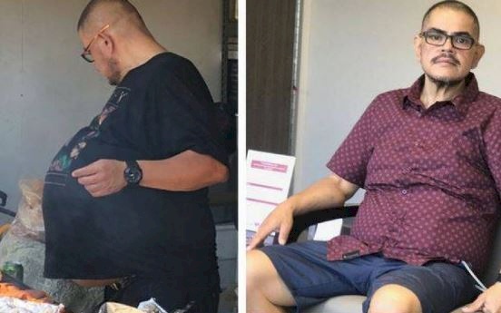 استأصلوا من بطنه ورماً بوزن 35 كيلو!