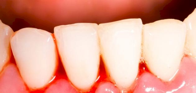 خروج الدم من الفم.. أسبابه ونصائح لعلاجه