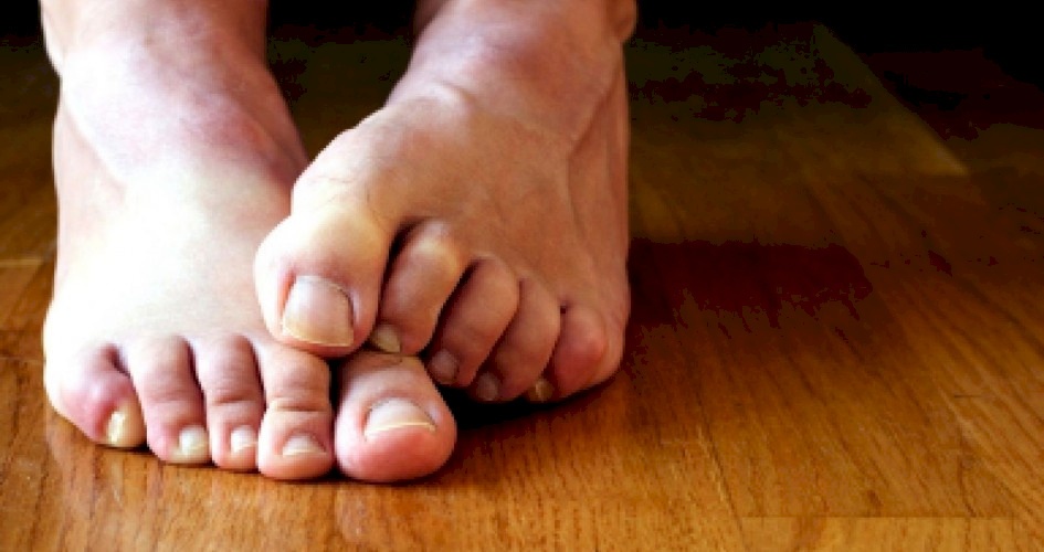  خطوات لعلاج فطريات القدم
