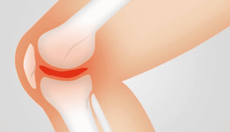 متى يستخدم الكورتيزون لعلاج التهاب المفاصل؟