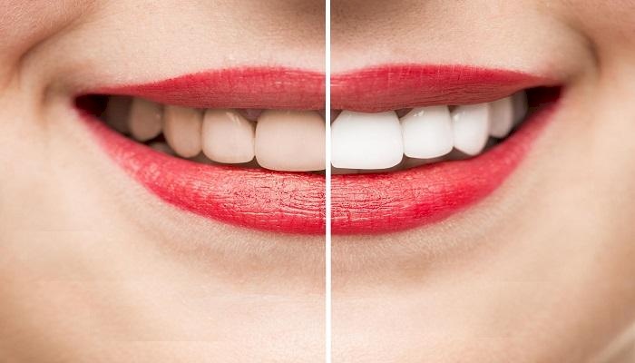 أطعمة نظّف أسنانك فورا بعد تناولها