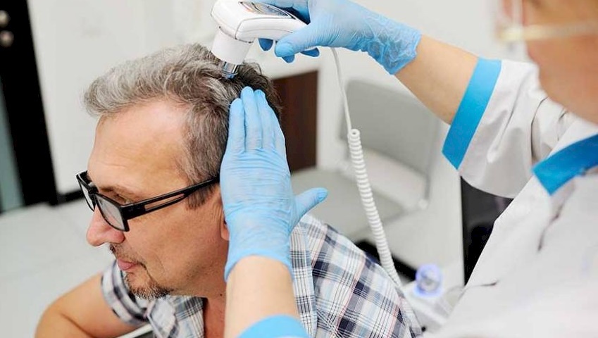 معلومات مهمة عن عملية زراعة الشعر