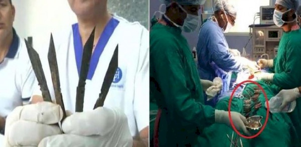 استخراج 40 سكيناً من معدة هندي بعملية استغرقت 5 ساعات