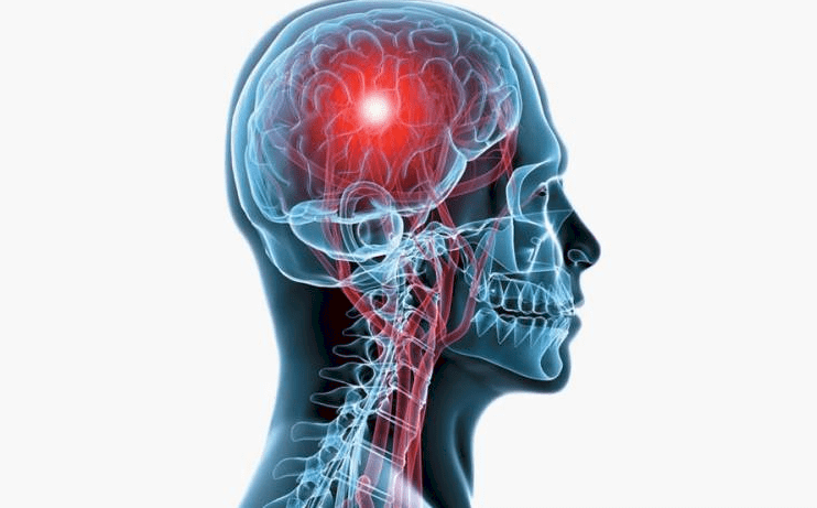 لماذا يصاب الشباب بالسكتة الدماغية؟