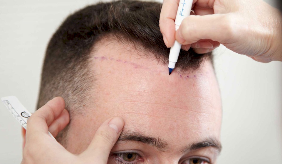 ما الذي يمكنك توقعه بعد زراعة الشعر؟