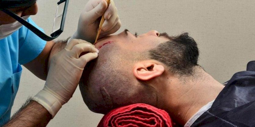 وفاة رجل بعد عملية زراعة شعر!