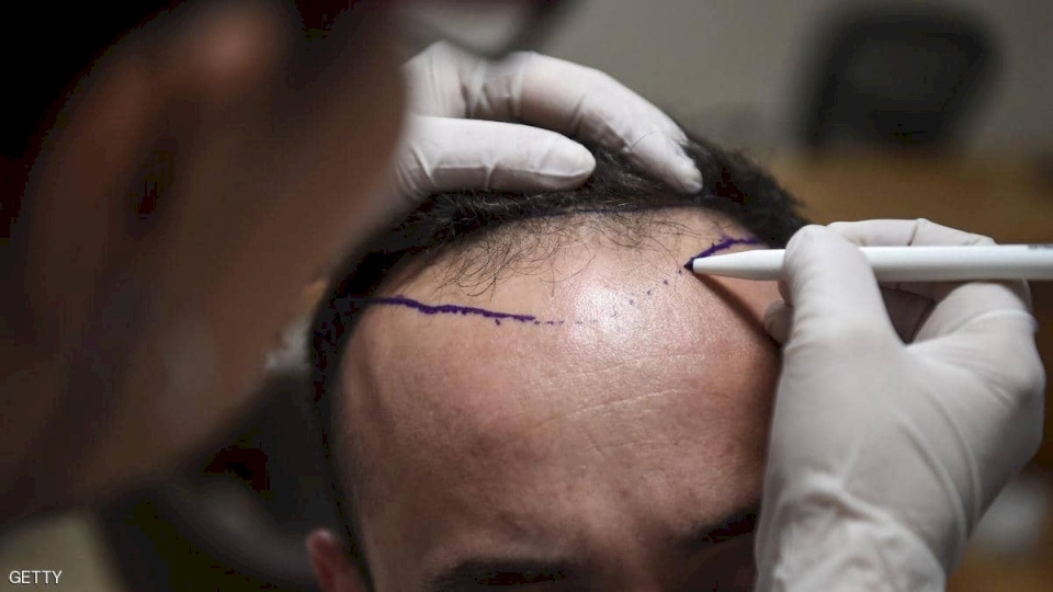 توفي بعد زراعته الشعر.. ماذا قال الاطباء؟ 