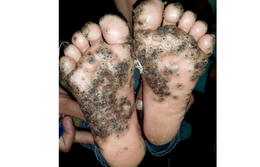 ترجمة خاصة: عدوى شنيعة لفتاة بعمر 10 سنوات بسبب هذا الشيء