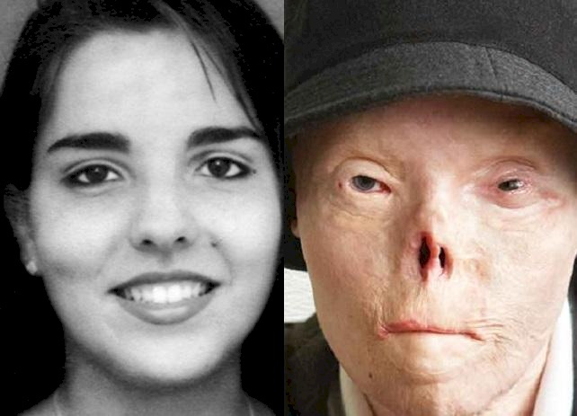 تعرف على قصتها الملهمة..شوهها حادث فباتت أيقونة للتوعية