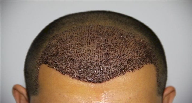 توفي بعد زراعته الشعر.. ماذا قال الاطباء؟