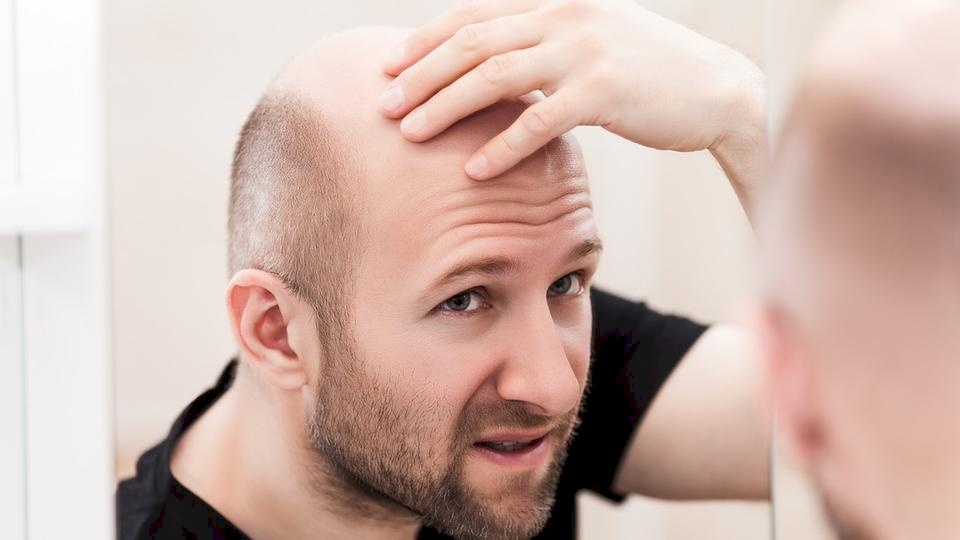 6 أفكار شائعة عن الصلع