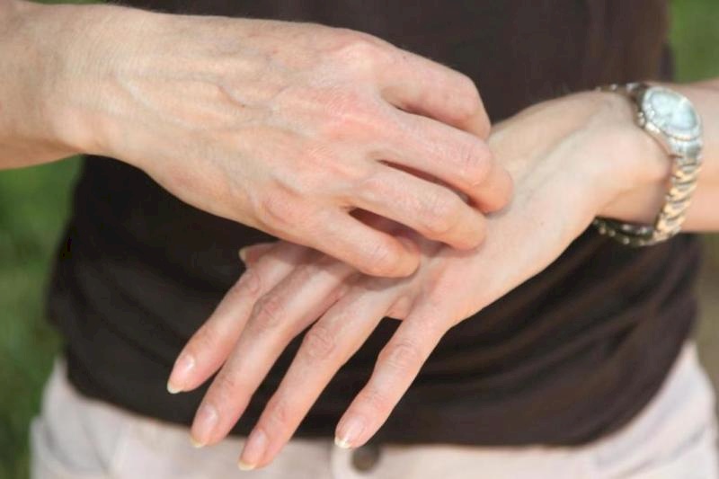 الجرب: مرض معدٍ يستدعي العلاج السريع