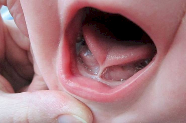 اللسان المربوط يعيق الطفل عن الرضاعة الطبيعية !