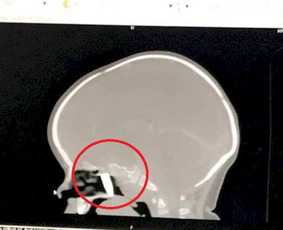 بالصور.. أطباء يستخرجون رصاصة من رأس رضيعة في نابلس