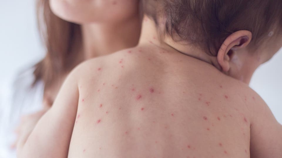 بعد إعلان أميركا خلوها من الحصبة.. 33 حالة والمرض يتفشى