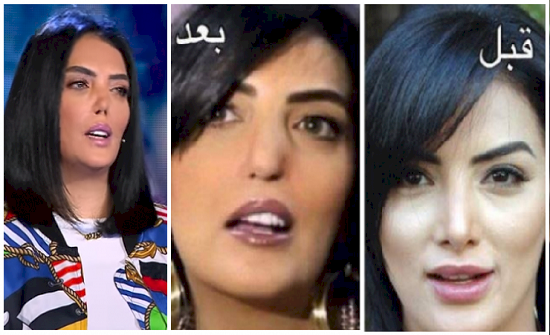 هل خضعت حورية فرغلي لعملية تجميل جديدة فاشلة؟